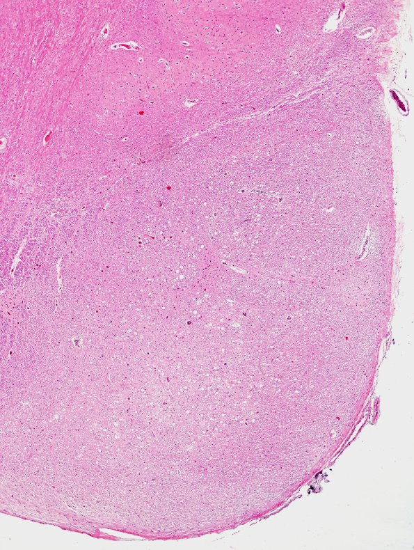 5C1 FULL MEDULLA FTLD-ALS (Case 5) L12 pyramid H&E 1.jpg