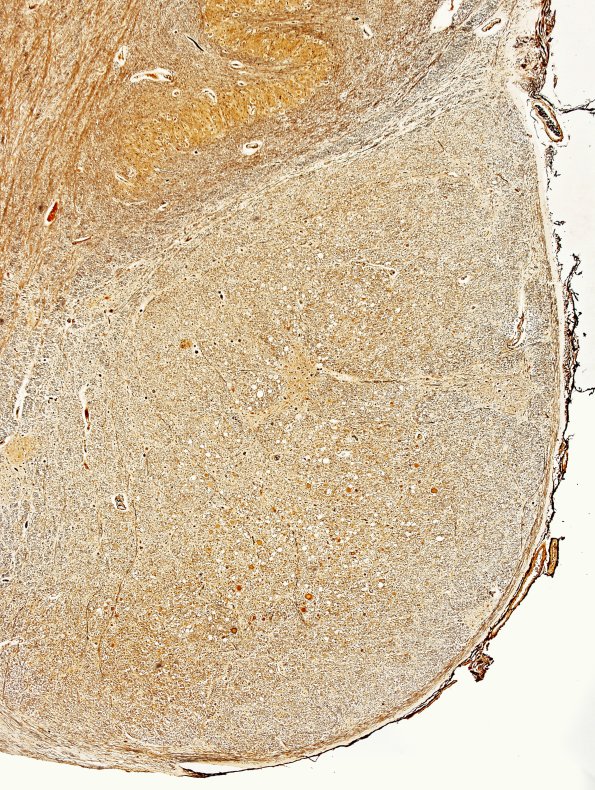 5D1 FTLD-ALS (Case 5) L12 Biels 6.jpg