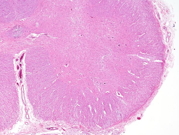 5F1 FTLD-ALS-TDP43 (Case 5) N13 H&E 5.jpg
