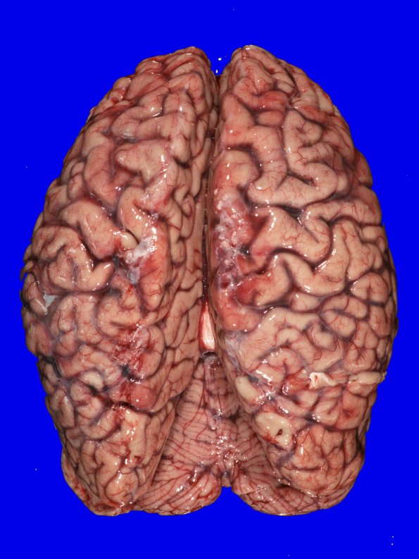 6A1 ALS (Case 6) spinal cord_1