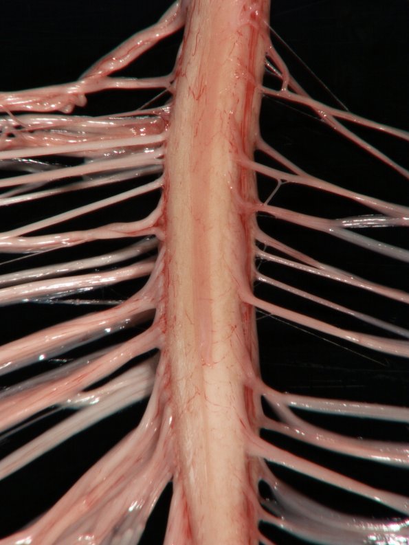 6A2 ALS (Case 6) spinal cord_4