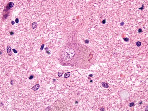 6B3 ALS (Case 6) Anterior Horn Neurons H&E 6