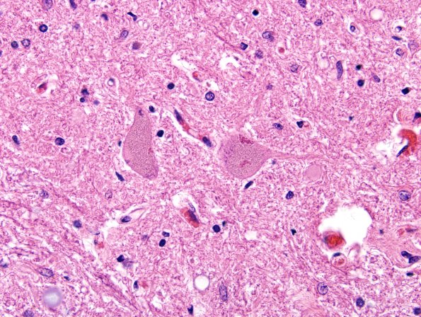 6B4 ALS (Case 6) Anterior Horn Neurons H&E 8