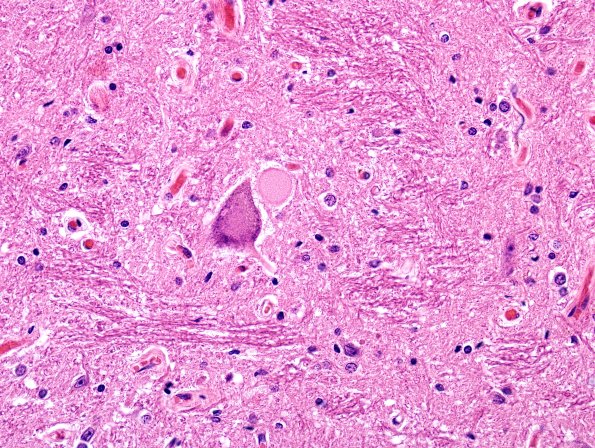 6B6 ALS (Case 6) Anterior Horn Neurons H&E 3