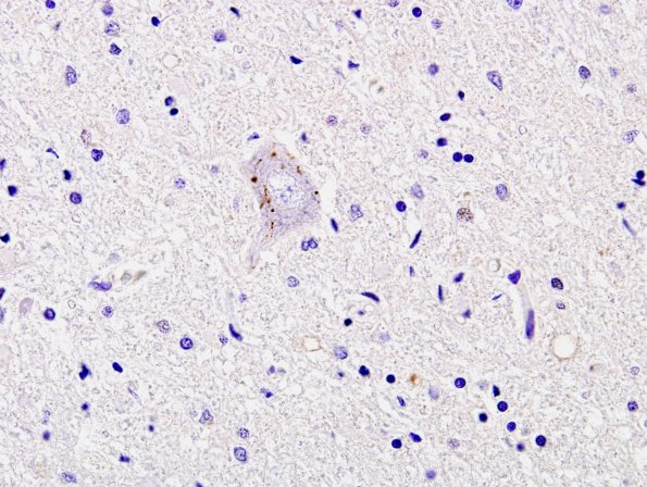 6C3 ALS (Case 6) Anterior Horn Neurons TDP43 4