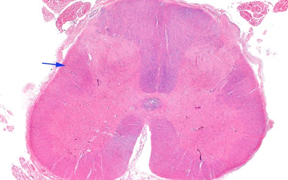 6D1 ALS (Case 6) spinal cord 2X copy