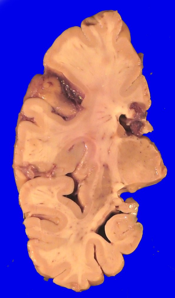 7A2 ALS & FTLD (Case 7)  _3