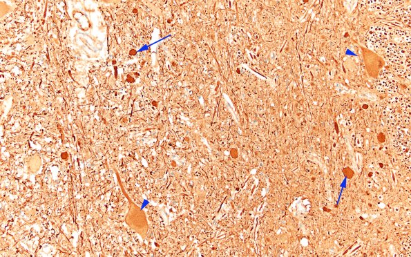 7G1 ALS (Case 7) N12 NF 20X copy