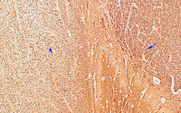 7H1 ALS (Case 7) N10 LatCS (L) vs Dorsal Column (R) NF copy