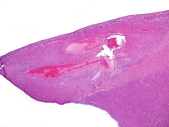 1A1 ARTAG (Case 1) L6 area A H&E 4X 1.jpg