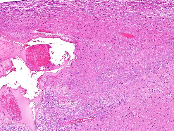 1A2 ARTAG (Case 1) L6 area A H&E 10X 1