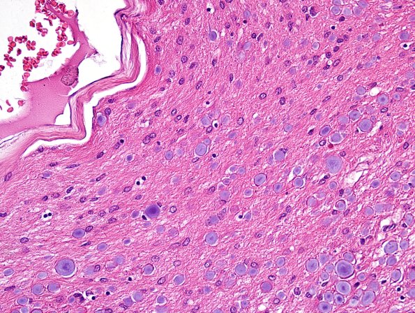 1A3 ARTAG (Case 1) L6 area A H&E 20X 2.jpg