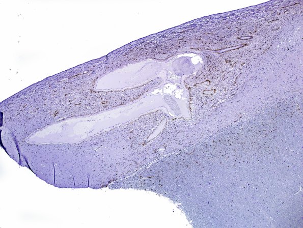 1B1 ARTAG (Case 1) L6 area A PHF1 4X 1.jpg