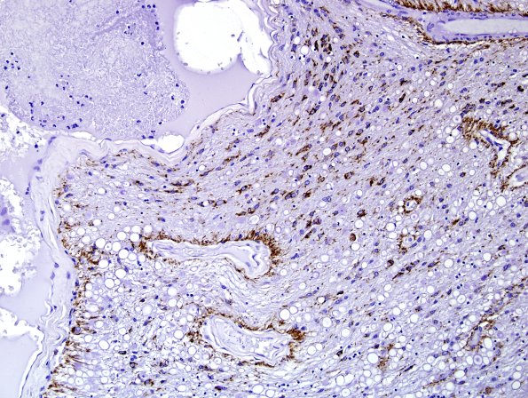 1B2 ARTAG (Case 1) L6 PHF1 9 area A.jpg