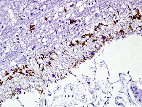 1B3 ARTAG (Case 1) L6 area B PHF1 9.jpg