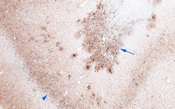 4A1 ARTAG (Case 4) Tau 2 copy