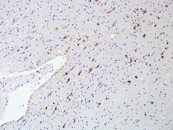 5A1 Age related tau astrogliopathy (ARTAG, Case 5) PHF1 4.jpg