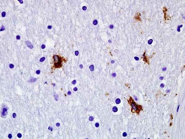 5A2 Age related tau astrogliopathy (ARTAG, Case 5) 100X PHF1 2.jpg