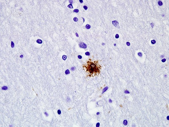 5A5 Age related tau astrogliopathy (ARTAG, Case 5) 100X PHF1 7.jpg