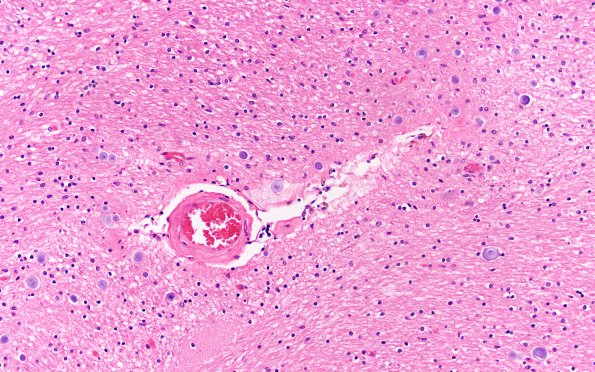 7A2 (Case 7) thorn ARTAG Astrocyte L23 H&E A