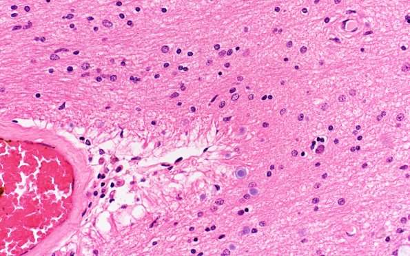 7A3 (Case 7) thorn ARTAG Astrocyte L23 H&E 40X