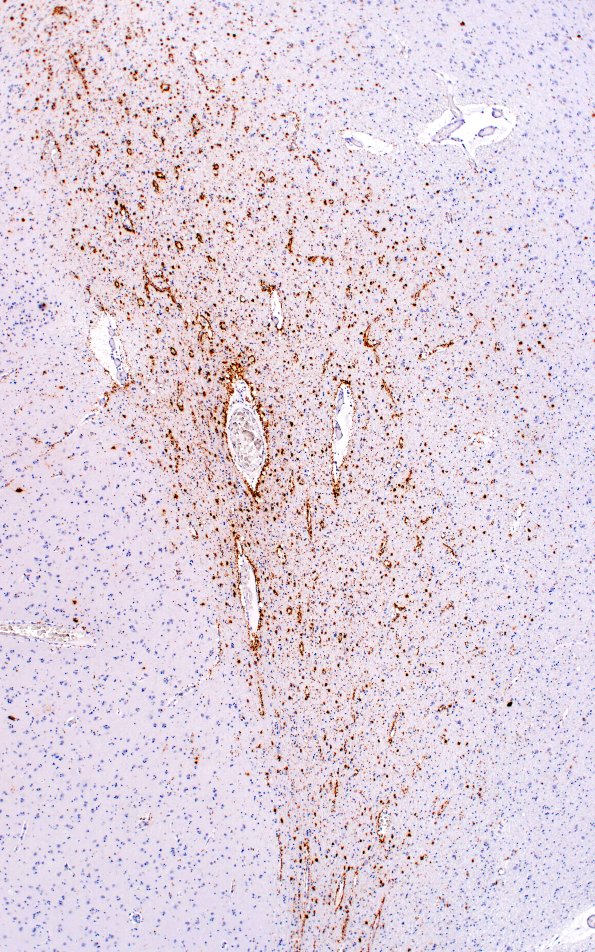 7B2A (Case 7) thorn ARTAG Astrocyte PHF1 4x