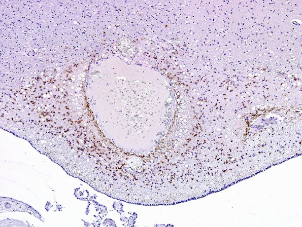 8B4 ARTAG (Case 8) PHF 10X.jpg