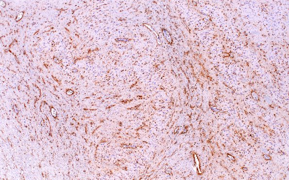 8C3 ARTAG (Case 8) L12 medulla PHF 4X