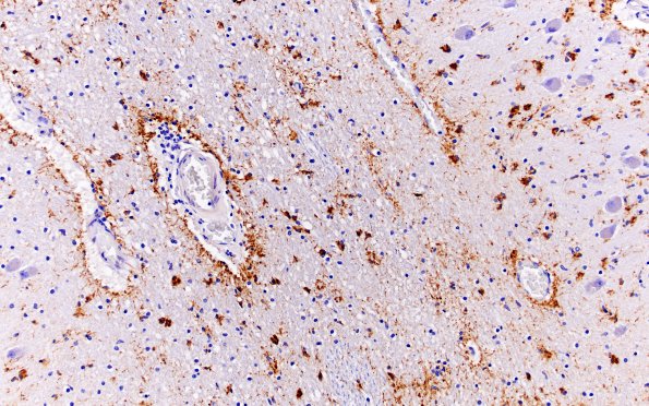 8C4 ARTAG (Case 8) L12 medulla PHF 20X