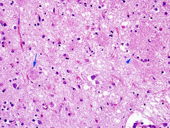 1A2 AD pure H&E 1 diffuse vs neuritic plaques copy