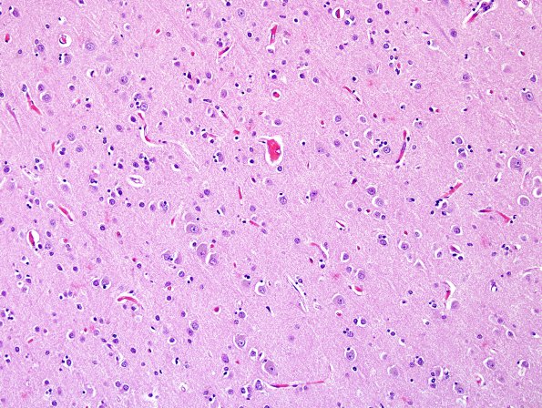 1A4 Senile Plaques, diffuse area A H&E 20X.jpg