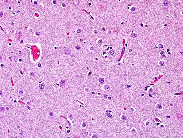 1A5 Senile Plaques, diffuse area A H&E 40X.jpg