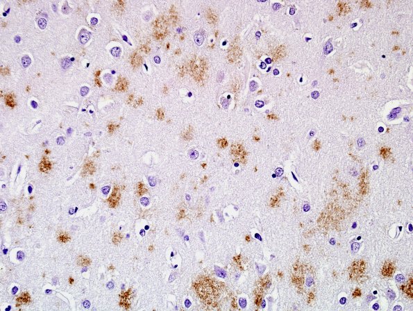 1B1 Senile Plaques, diffuse area A BAmyloid 20X.jpg