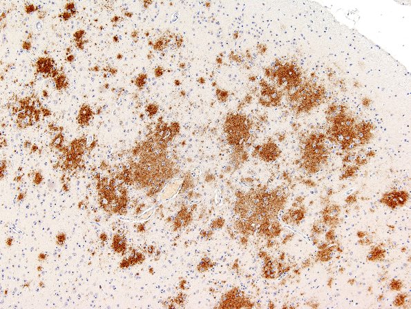 1B3 AD diffuse plaques BAmyloid 1