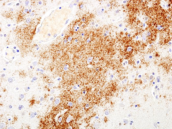 1B5 AD diffuse plaques BAmyloid 3