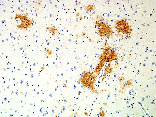 1B7 Alz Changes, Diffuse Plaque Cortex BAmyloid 1