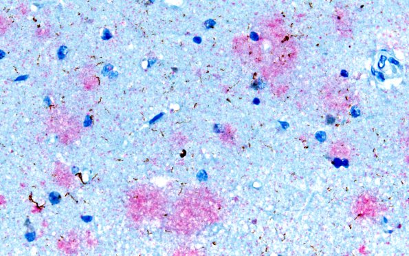 1D4 AD changes, Amyloid red, pTau brown 7