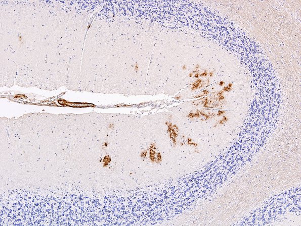 1E AD, APP Swedish mutation BAmyloid cerebellum 3.jpg