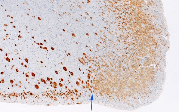 2A2 AD (Presenilin 1 mutation) Abeta 4X copy