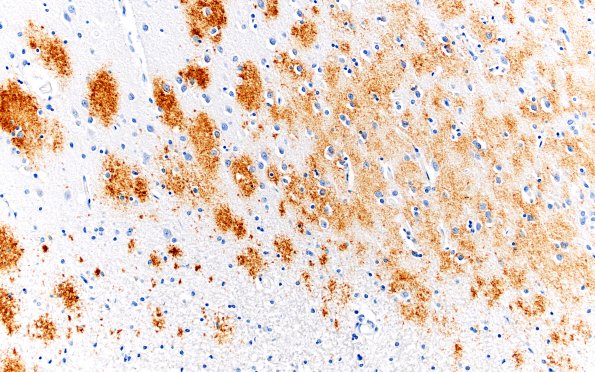 2A3 AD (Presenilin 1 mutation) Abeta 20X