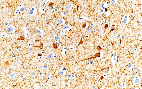 2C4 AD (Presenilin 1 mutation) PHF 40X diffuse area