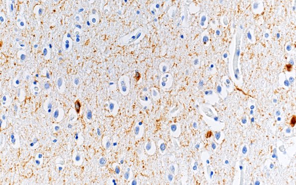 2C5 AD (Presenilin 1 mutation) PHF 40X fleecy area