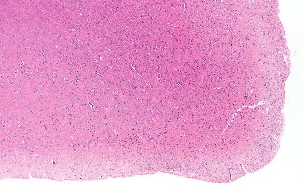 2D2 AD (Presenilin 1 mutation) H&E 4X