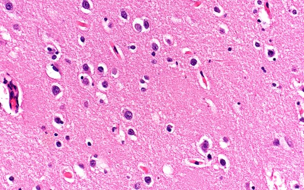 2D3 AD (Presenilin 1 mutation) H&E 40X diffuse area