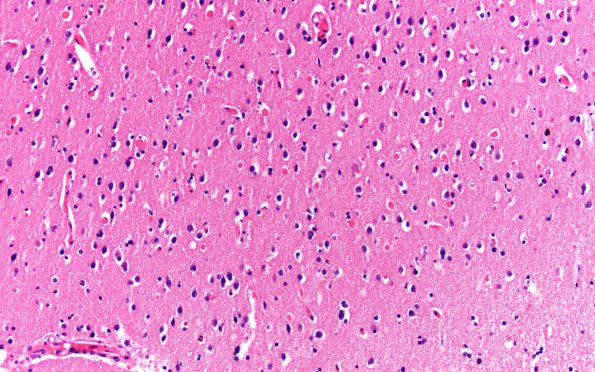 2D4 AD (Presenilin 1 mutation) H&E 20X fleecy area