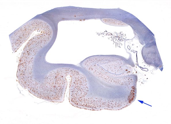 2E1 AD L5 B-Amyloid WM