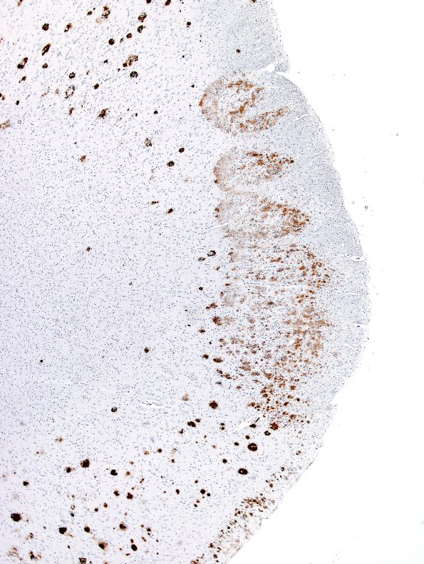 2E2 AD & DLBD & Congophilic Angiopathy (CAA) L5 B-Amyloid 2