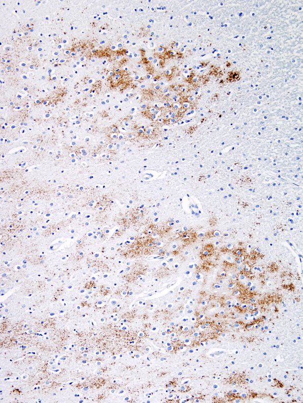 2E3 AD & DLBD & Congophilic Angiopathy (CAA) L5 B-Amyloid 1