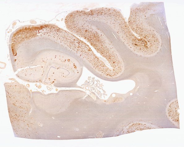 2F1 AD N3 1 B-amyloid WM