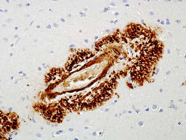 2G4 AD BAmyloid (perivascular) 1